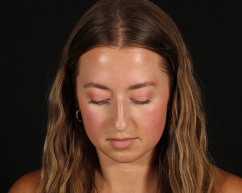 Rhinoplasty Female Before & After Gallery - Patient 276612 - Image 7