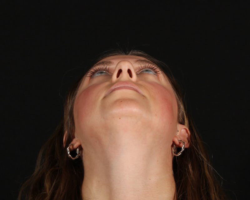 Rhinoplasty Female Before & After Gallery - Patient 276612 - Image 9