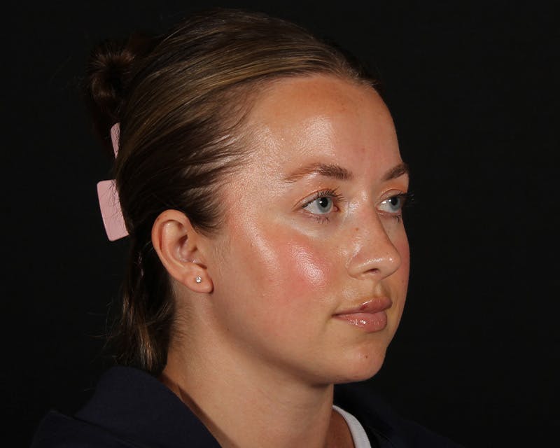 Rhinoplasty Female Before & After Gallery - Patient 276612 - Image 12