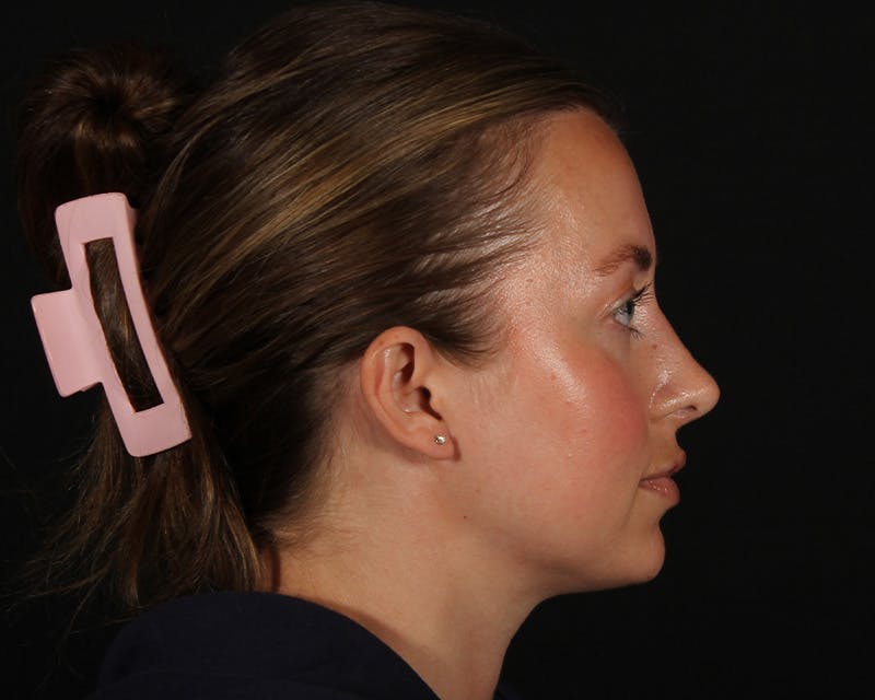 Rhinoplasty Female Before & After Gallery - Patient 276612 - Image 14