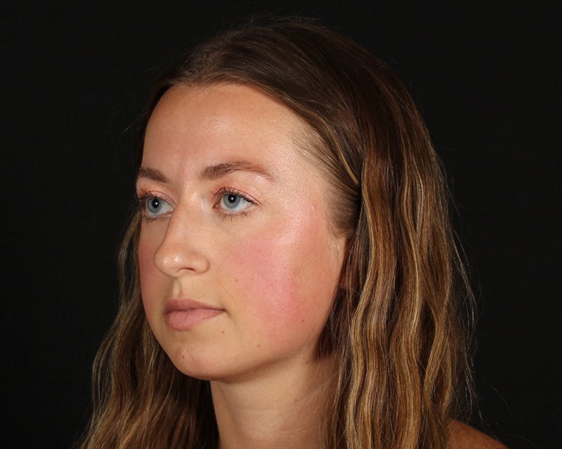 Rhinoplasty Female Before & After Gallery - Patient 276612 - Image 3
