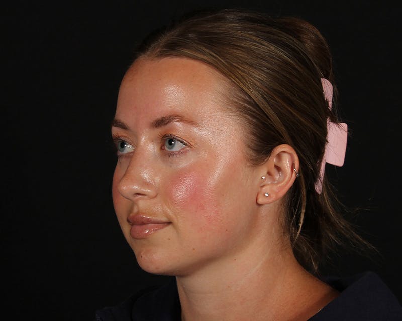 Rhinoplasty Female Before & After Gallery - Patient 276612 - Image 4