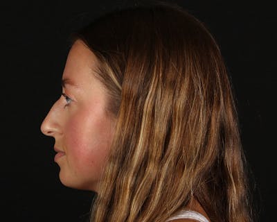 Rhinoplasty Female Before & After Gallery - Patient 276612 - Image 1