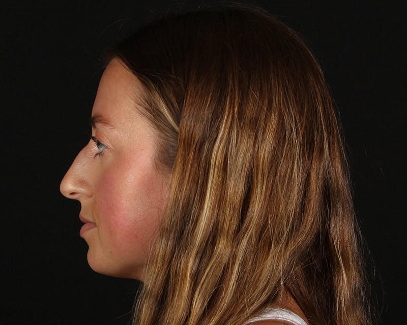 Rhinoplasty Female Before & After Gallery - Patient 276612 - Image 1