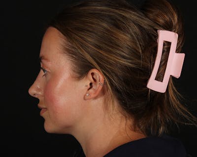 Rhinoplasty Female Before & After Gallery - Patient 276612 - Image 2