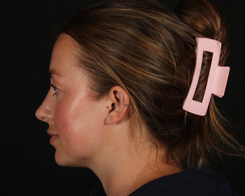 Rhinoplasty Female Before & After Gallery - Patient 276612 - Image 2