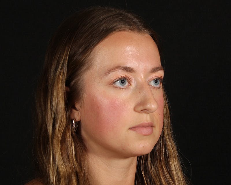 Rhinoplasty Female Before & After Gallery - Patient 276612 - Image 11