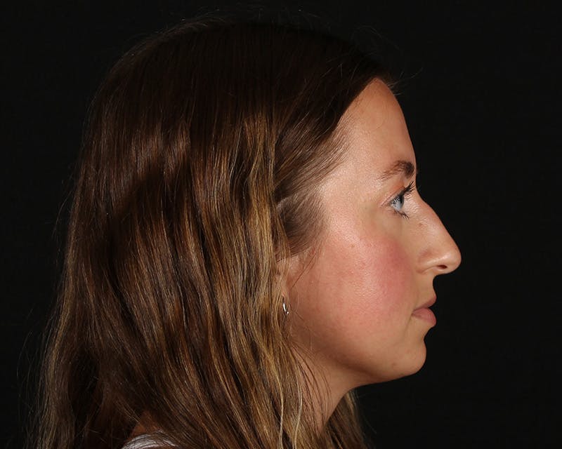 Rhinoplasty Female Before & After Gallery - Patient 276612 - Image 13