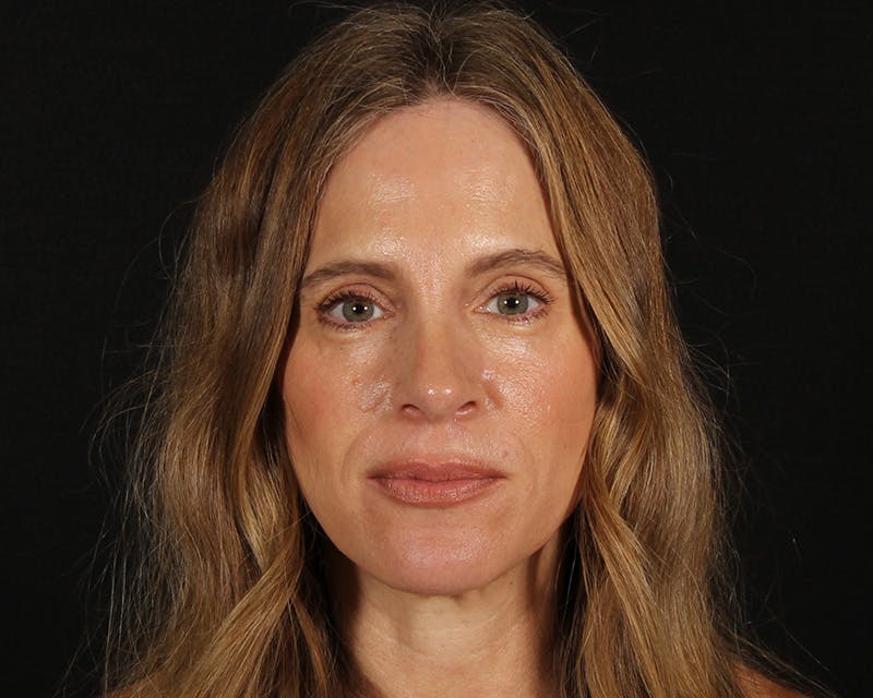 Rhinoplasty Female Before & After Gallery - Patient 218793 - Image 6