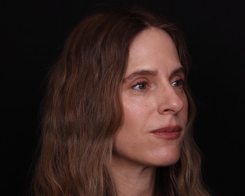 Rhinoplasty Female Before & After Gallery - Patient 218793 - Image 11