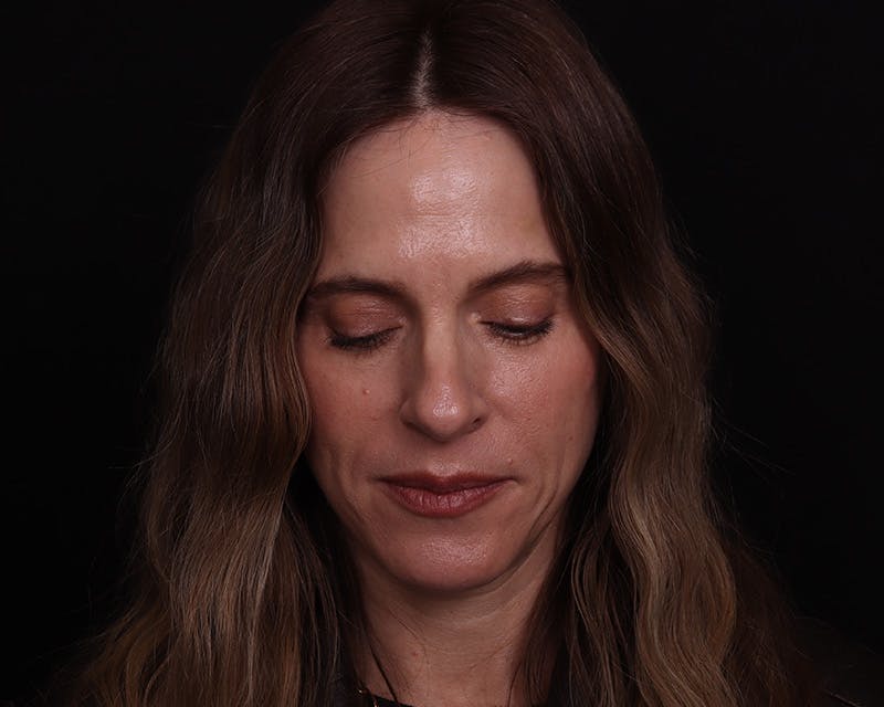 Rhinoplasty Female Before & After Gallery - Patient 218793 - Image 7