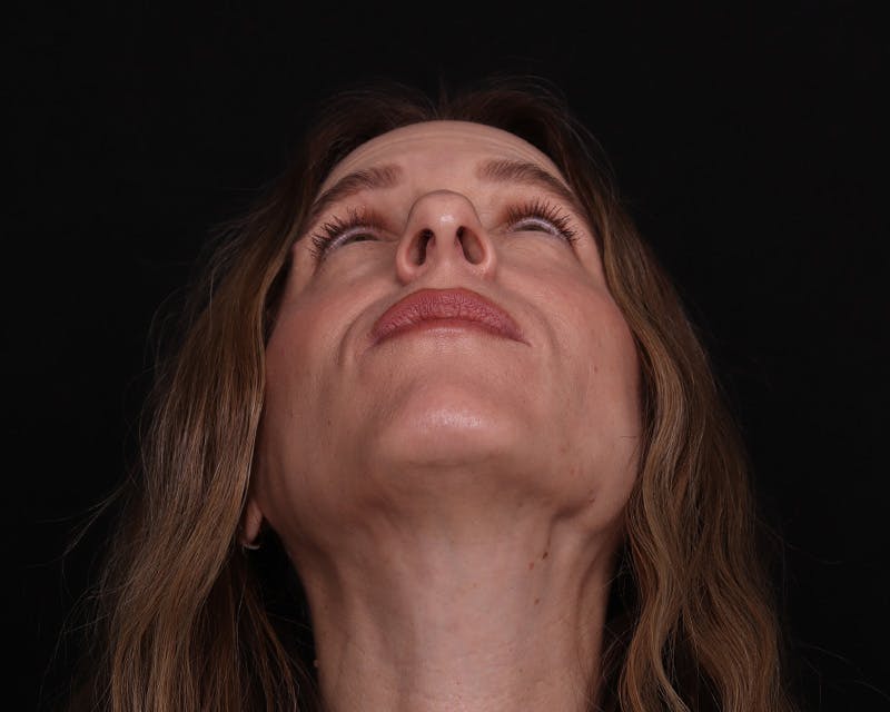 Rhinoplasty Female Before & After Gallery - Patient 218793 - Image 9