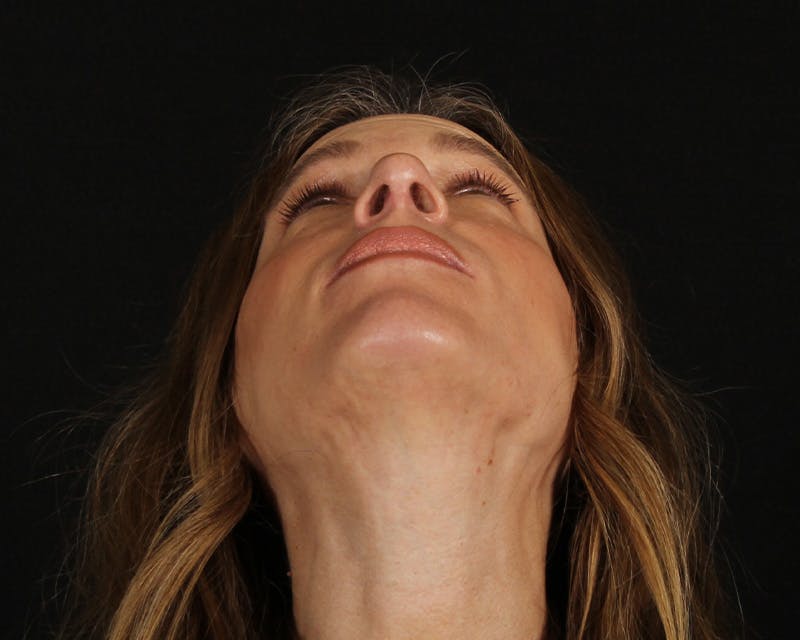 Rhinoplasty Female Before & After Gallery - Patient 218793 - Image 10