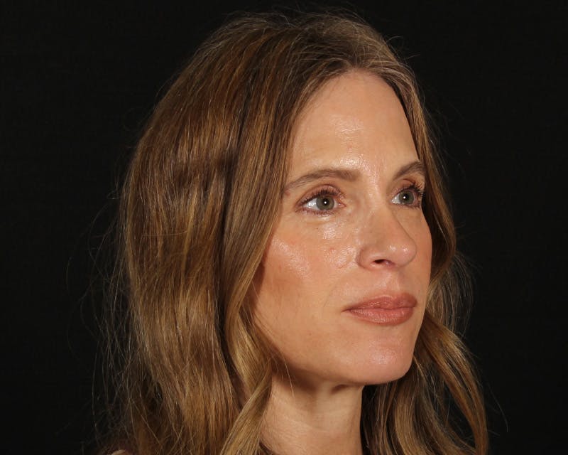 Rhinoplasty Female Before & After Gallery - Patient 218793 - Image 12