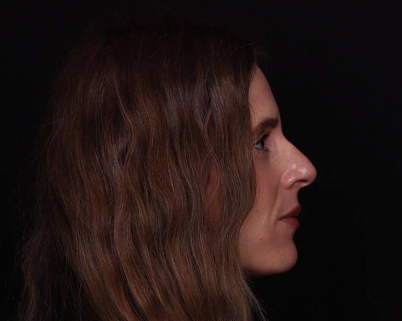 Rhinoplasty Female Before & After Gallery - Patient 218793 - Image 13