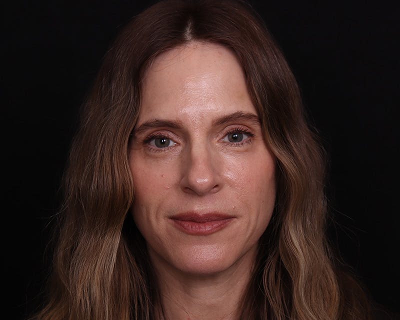 Rhinoplasty Female Before & After Gallery - Patient 218793 - Image 5