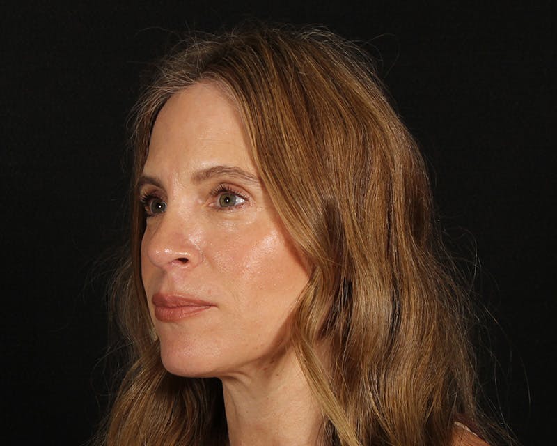 Rhinoplasty Female Before & After Gallery - Patient 218793 - Image 4