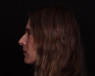 Rhinoplasty Female Before & After Gallery - Patient 218793 - Image 1