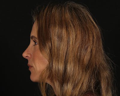 Rhinoplasty Female Before & After Gallery - Patient 218793 - Image 2