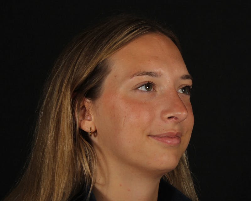 Rhinoplasty Female Before & After Gallery - Patient 131093 - Image 8