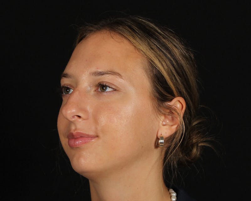 Rhinoplasty Female Before & After Gallery - Patient 131093 - Image 3