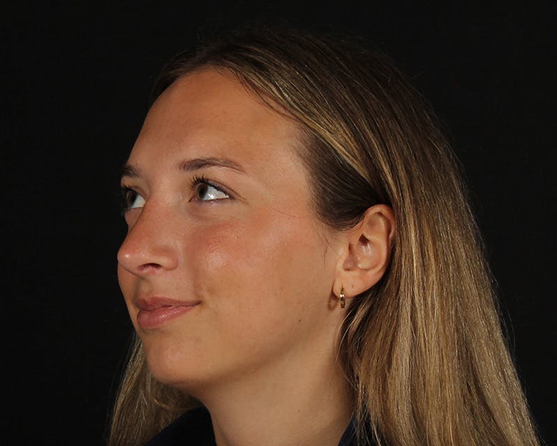 Rhinoplasty Female Before & After Gallery - Patient 131093 - Image 4