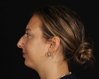 Rhinoplasty Female Before & After Gallery - Patient 131093 - Image 1