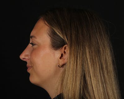 Rhinoplasty Female Before & After Gallery - Patient 131093 - Image 2