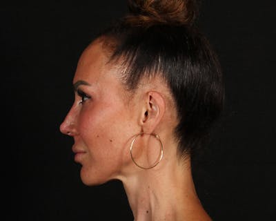 Rhinoplasty Female Before & After Gallery - Patient 447009 - Image 1