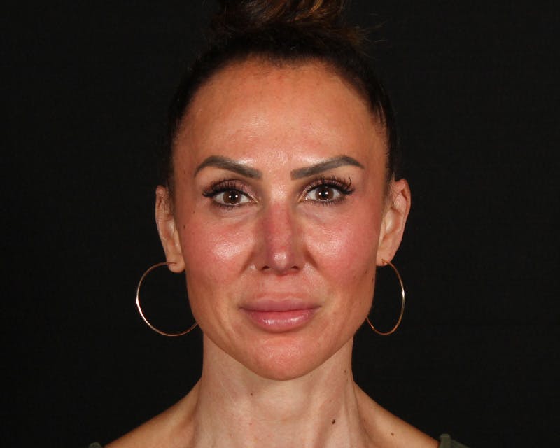 Rhinoplasty Female Before & After Gallery - Patient 447009 - Image 5