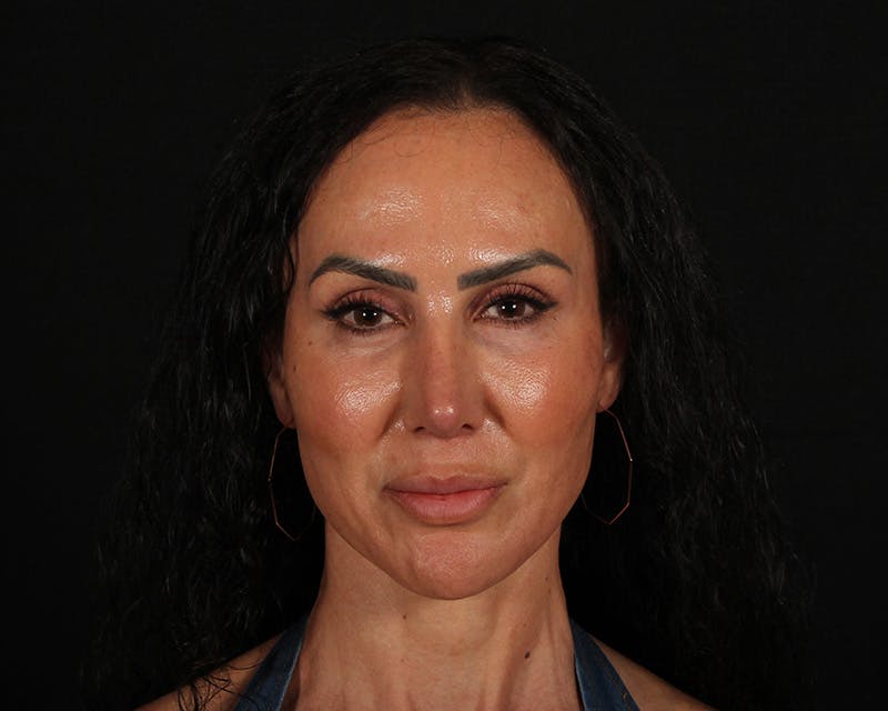 Rhinoplasty Female Before & After Gallery - Patient 447009 - Image 6