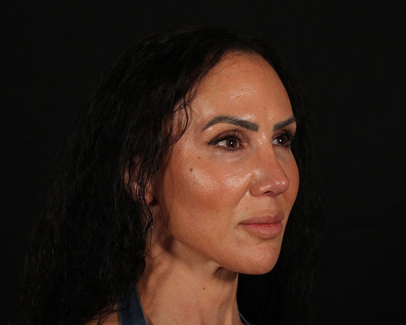 Rhinoplasty Female Before & After Gallery - Patient 447009 - Image 12