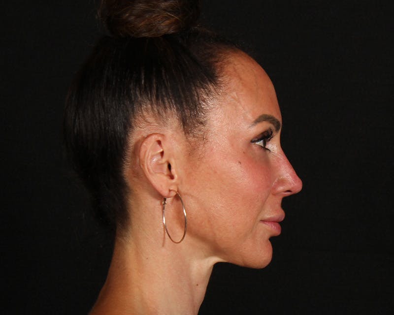 Rhinoplasty Female Before & After Gallery - Patient 447009 - Image 13