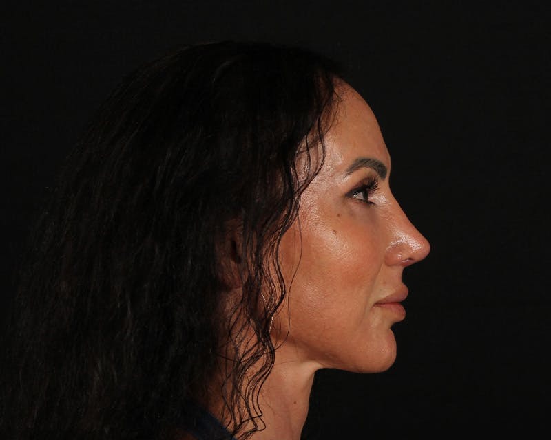 Rhinoplasty Female Before & After Gallery - Patient 447009 - Image 14