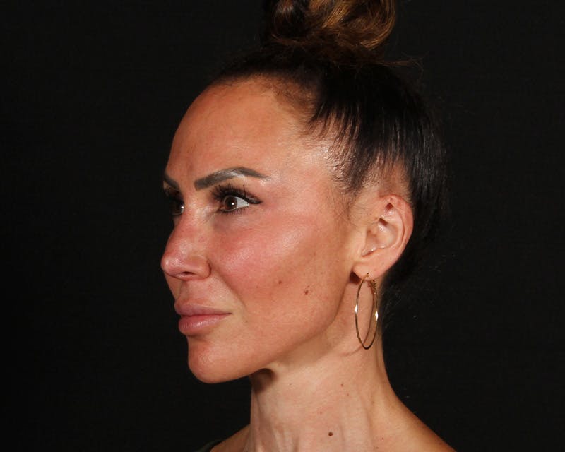 Rhinoplasty Female Before & After Gallery - Patient 447009 - Image 3
