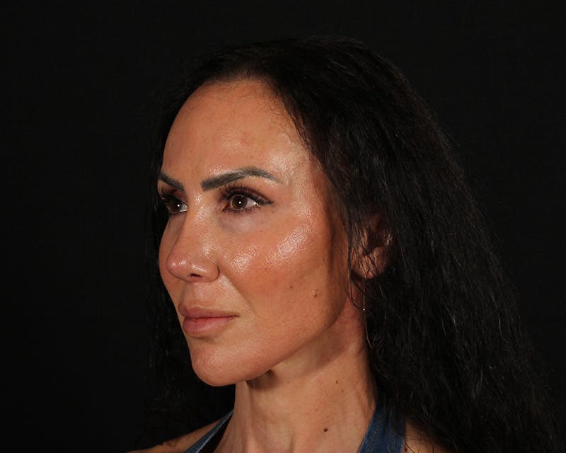 Rhinoplasty Female Before & After Gallery - Patient 447009 - Image 4