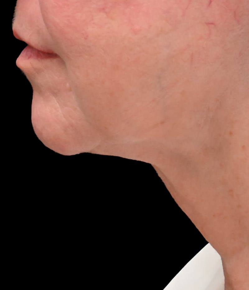 Deep Plane Facelift & Neck Lift Before & After Gallery - Patient 809306 - Image 8