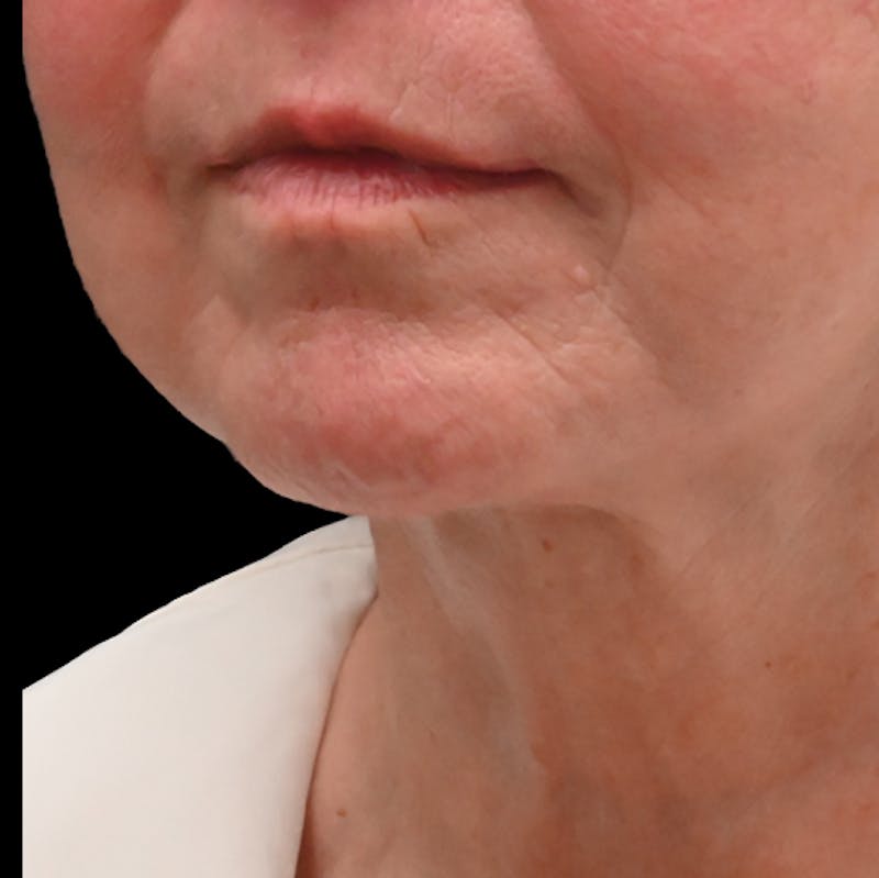 Deep Plane Facelift & Neck Lift Before & After Gallery - Patient 809306 - Image 4