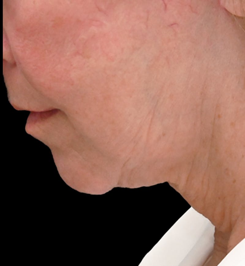 Deep Plane Facelift & Neck Lift Before & After Gallery - Patient 809306 - Image 6
