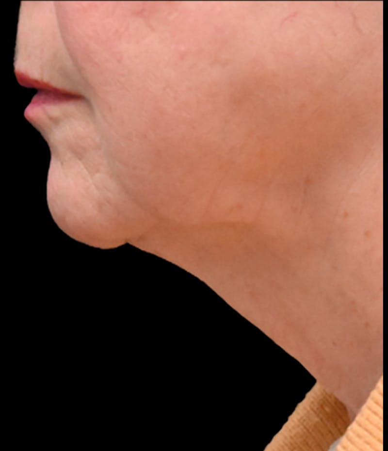 Deep Plane Facelift & Neck Lift Before & After Gallery - Patient 809306 - Image 7