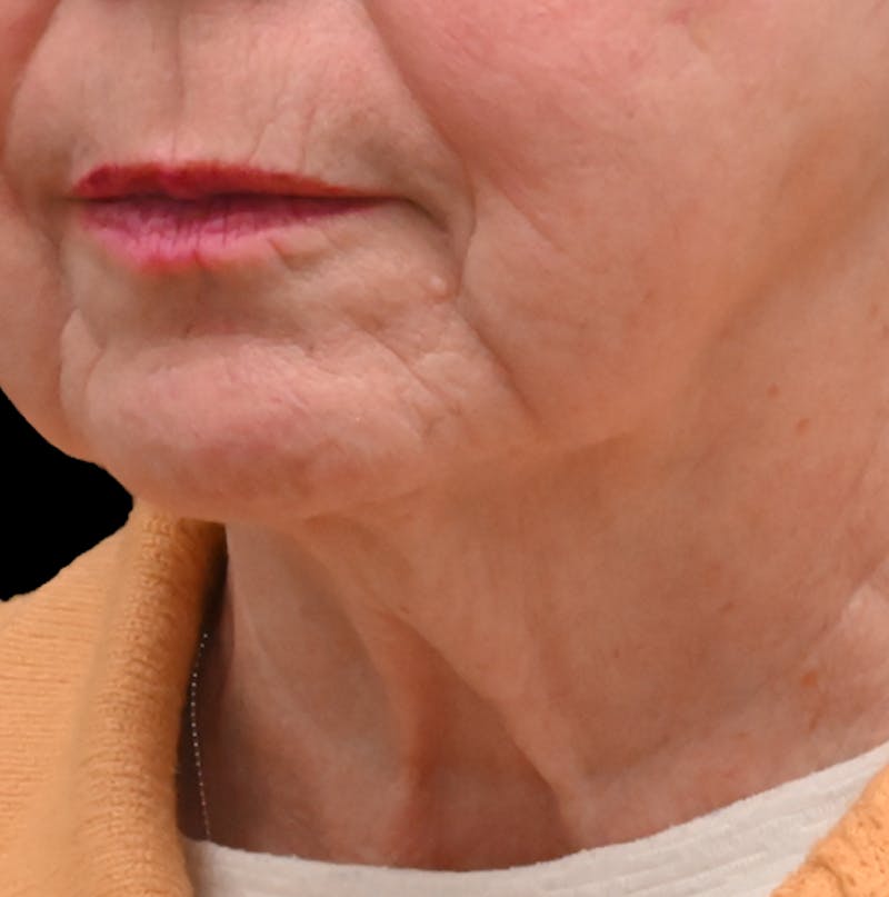 Deep Plane Facelift & Neck Lift Before & After Gallery - Patient 809306 - Image 3