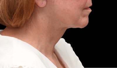 Deep Plane Facelift & Neck Lift Before & After Gallery - Patient 809306 - Image 2