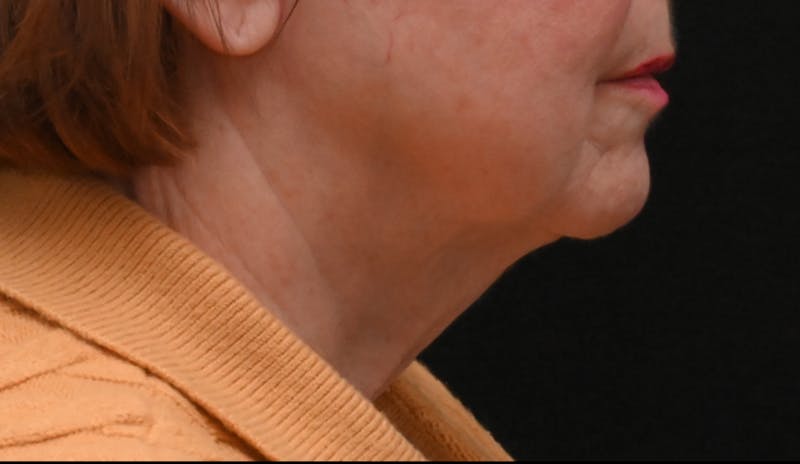 Deep Plane Facelift & Neck Lift Before & After Gallery - Patient 809306 - Image 1