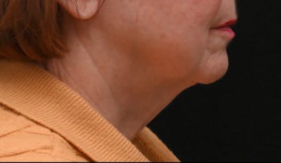 Deep Plane Facelift & Neck Lift Before & After Gallery - Patient 809306 - Image 1