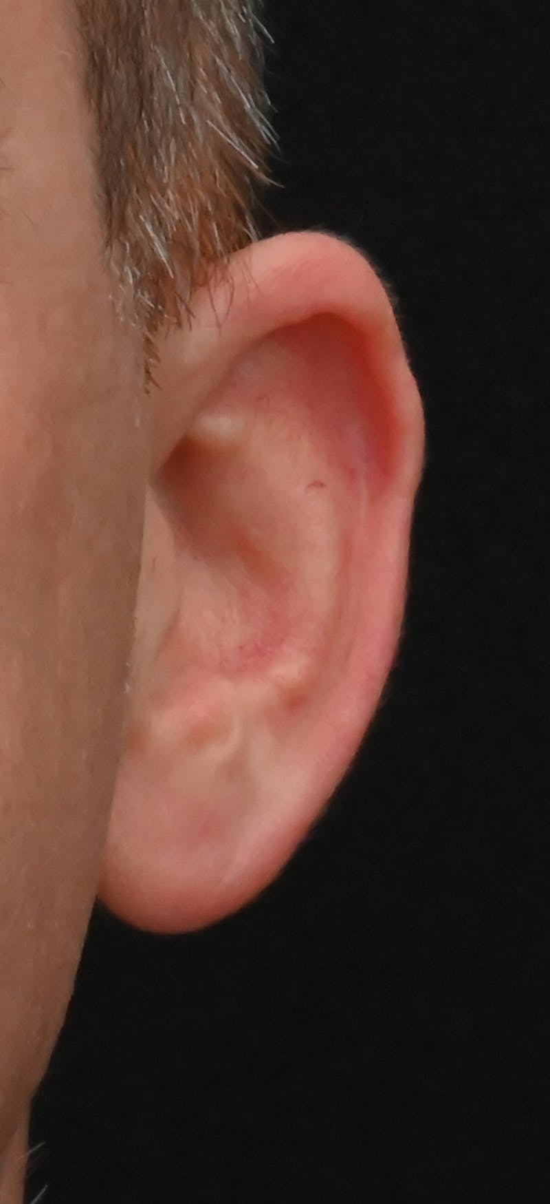 Otoplasty Before & After Gallery - Patient 293602 - Image 3