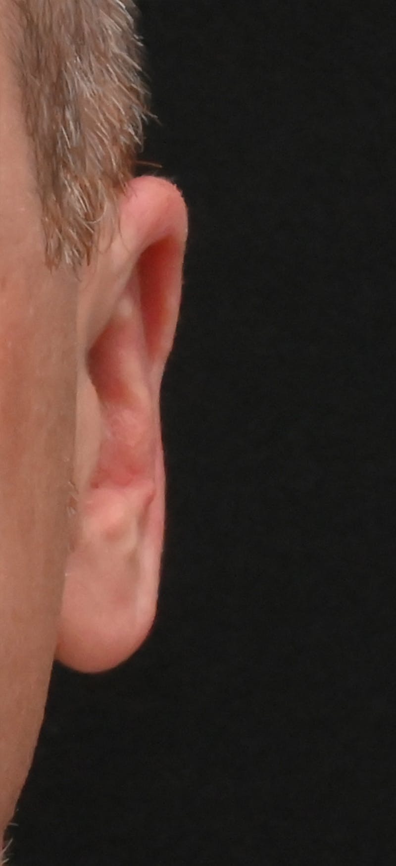 Otoplasty Before & After Gallery - Patient 293602 - Image 4