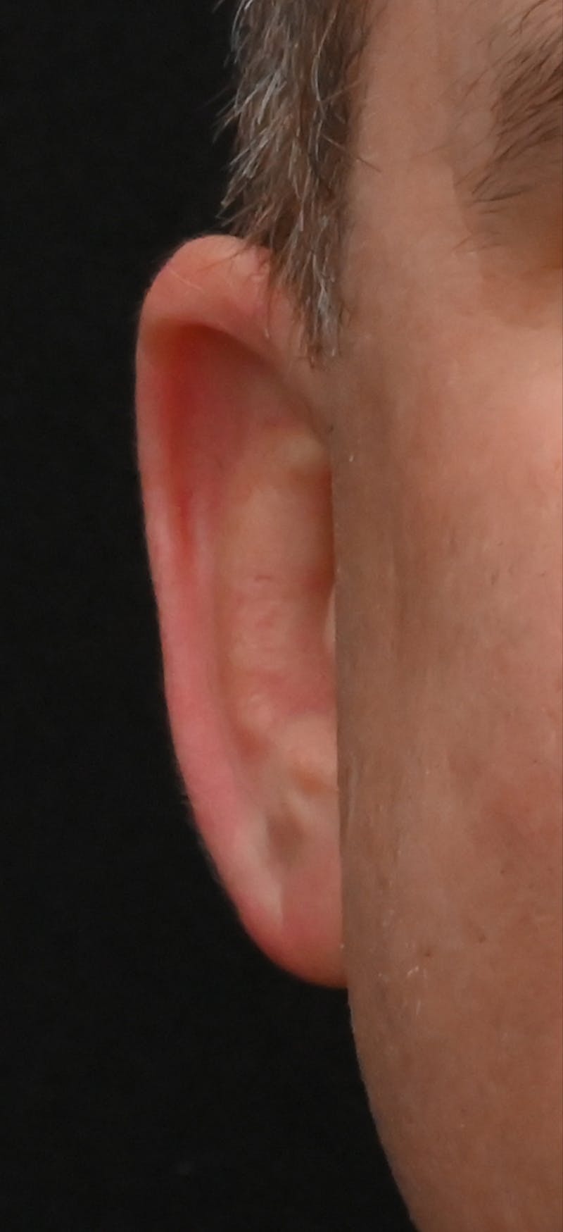 Otoplasty Before & After Gallery - Patient 293602 - Image 1