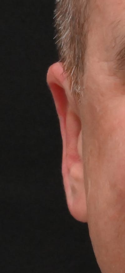 Otoplasty Before & After Gallery - Patient 293602 - Image 2