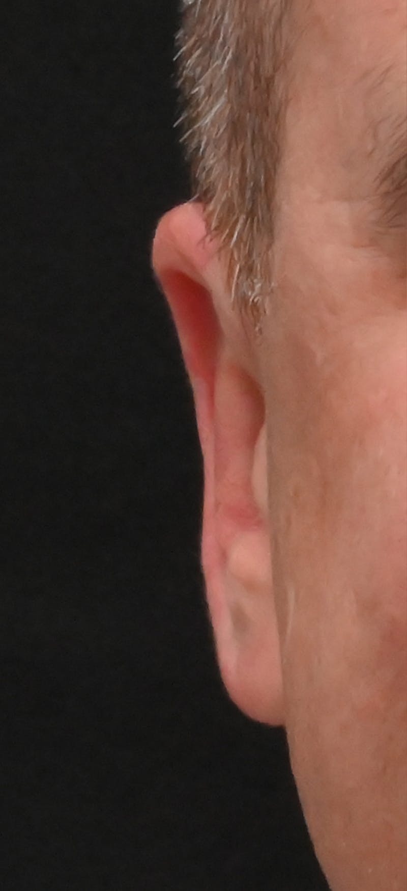 Otoplasty Before & After Gallery - Patient 293602 - Image 2