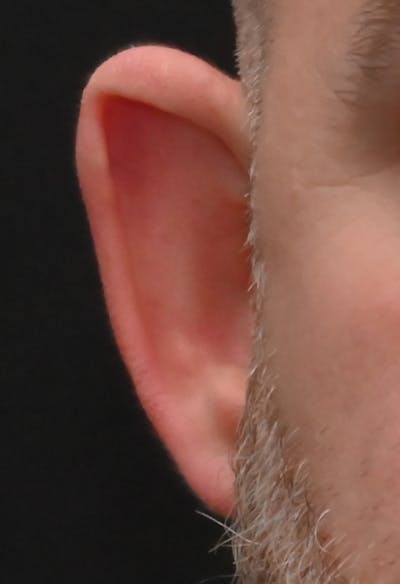 Otoplasty Before & After Gallery - Patient 399752 - Image 1